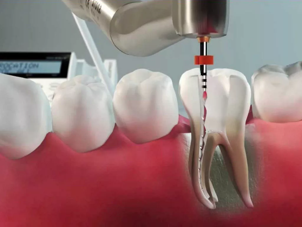 Что такое корневой канал зуба