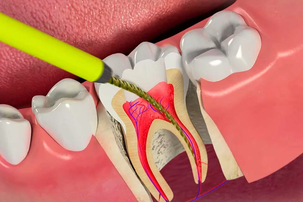 Больно ли лечить каналы зубов